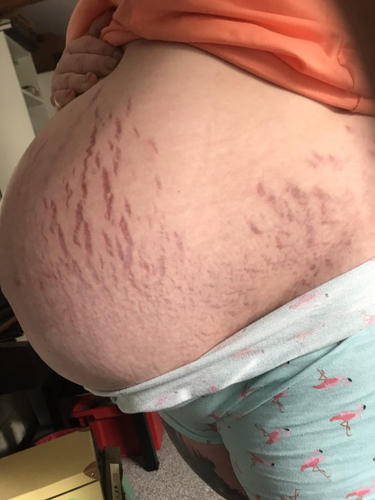 Twin Pregnancy – stretch marks